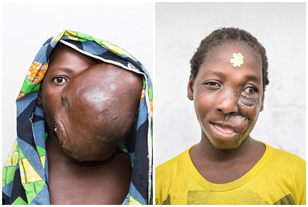 Cô bé 12 tuổi sắp phải lìa đời vì khối u lớn nuốt trọn khuôn mặt thì may mắn được cứu
