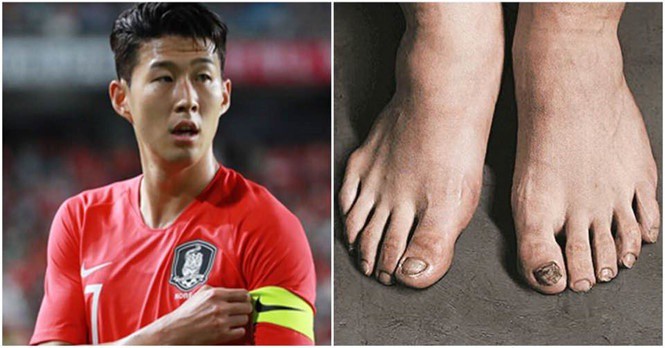 Fan xót xa trước đôi bàn chân biến dạng của Son Heung-min sau thời gian dài thi đấu liên tục không nghỉ
