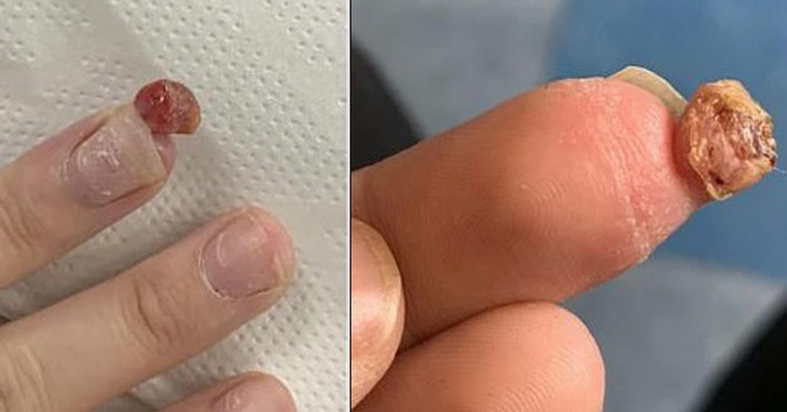 Cô gái suýt mất cả ngón tay vì thói quen làm móng tại cơ sở không đảm bảo