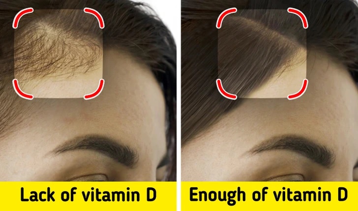 7 dấu hiệu quan trọng cho thấy bạn đang thiếu vitamin D